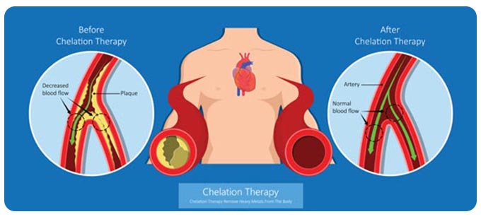 Chelation Therapy Clinic Near Me in South Surrey BC