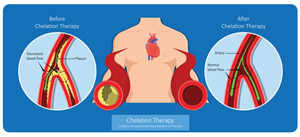 Chelation Therapy Clinic Near Me in South Surrey BC