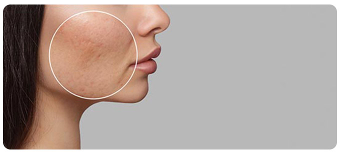 Hyperpigmentation Treatment Near Me in South Surrey BC