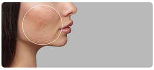 Hyperpigmentation Treatment Near Me in South Surrey BC