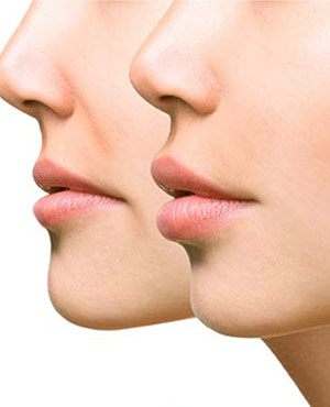 Nasolabial Fold Fillers Near Me in South Surrey BC 