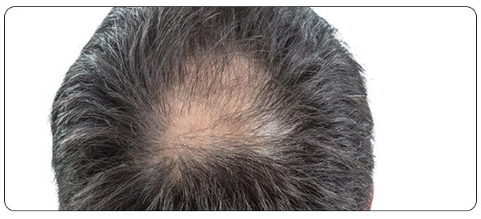 PRP Hair Restoration Near Me in South Surrey BC, and Burnaby BC PRP Hair Restoration Near Me in South Surrey BC, and Burnaby BC