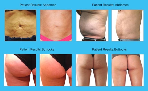 Venus Legacy Treatment Before & After Near Me in South Surrey BC Venus Legacy Treatment Before & After Near Me in South Surrey BC