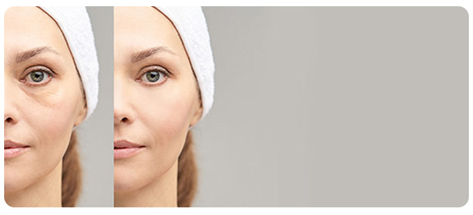 Under Eye Filler Near Me in South Surrey BC Under Eye Filler Near Me in South Surrey BC