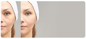 Under Eye Filler Near Me in South Surrey BC Under Eye Filler Near Me in South Surrey BC