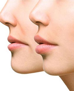 Nasolabial Fold Fillers Near Me in South Surrey BC