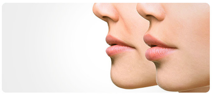 Nasolabial Fold Fillers Near Me in South Surrey BC