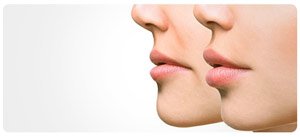 Nasolabial Fold Fillers Near Me in South Surrey BC