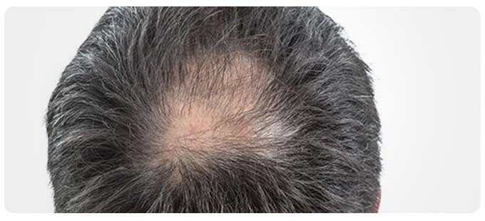 PRP Hair Restoration Therapy Near Me in South Surrey BC