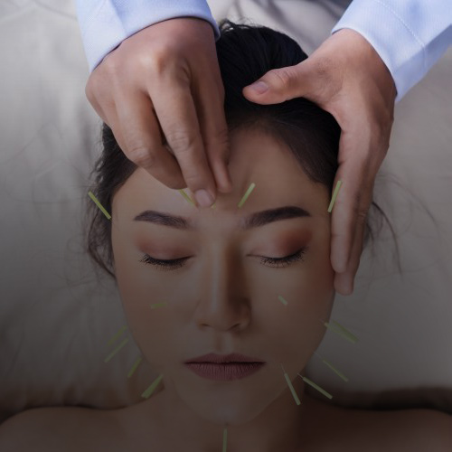 Acupuncture