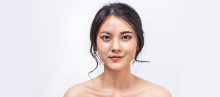 Before and After Treatment at Mediworks Rejuvenation Centre Located in South Surrey BC