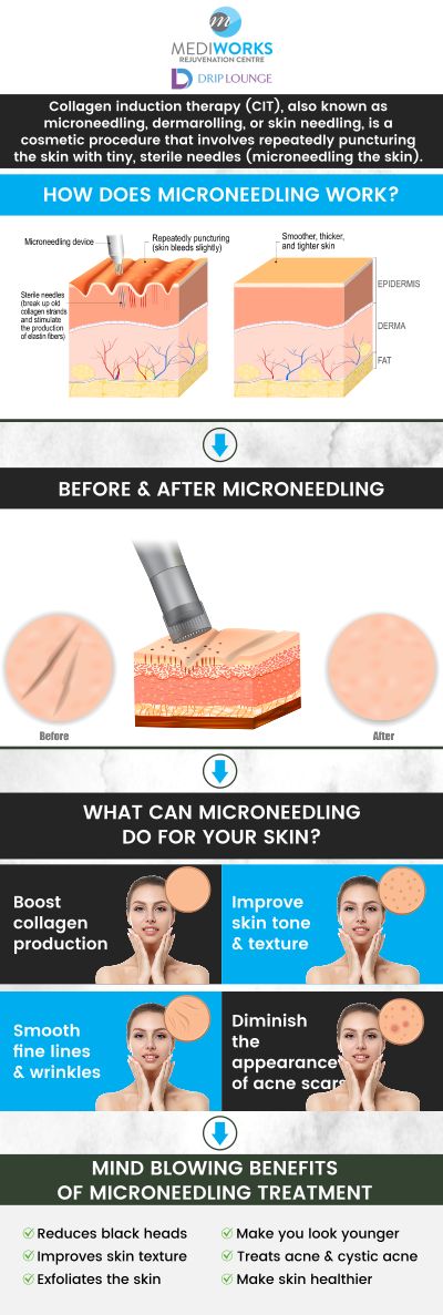 Are you looking to reduce fine lines, wrinkles, or scars? Microneedling is one solution for you offered at Mediworks Rejuvenation Centre. For more information, contact us or book an appointment online. We are conveniently located at Unit #103 – 15222 32nd Avenue Diversion, Surrey, BC V3Z 0R8, Canada. Are you looking to reduce fine lines, wrinkles, or scars? Microneedling is one solution for you offered at Mediworks Rejuvenation Centre. For more information, contact us or book an appointment online. We are conveniently located at Unit #103 – 15222 32nd Avenue Diversion, Surrey, BC V3Z 0R8, Canada.