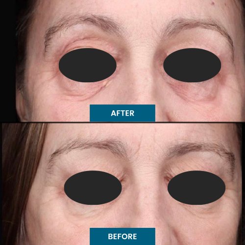 Exosome Facial Treatment in South Surrey, BC Exosome Facial Treatment in South Surrey, BC