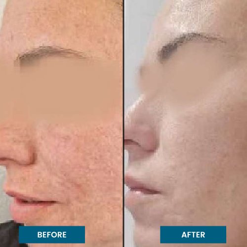 Exosome Facial Treatment in South Surrey, BC Exosome Facial Treatment in South Surrey, BC