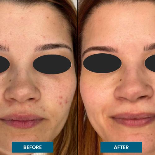 Exosome Facial Treatment in South Surrey, BC Exosome Facial Treatment in South Surrey, BC