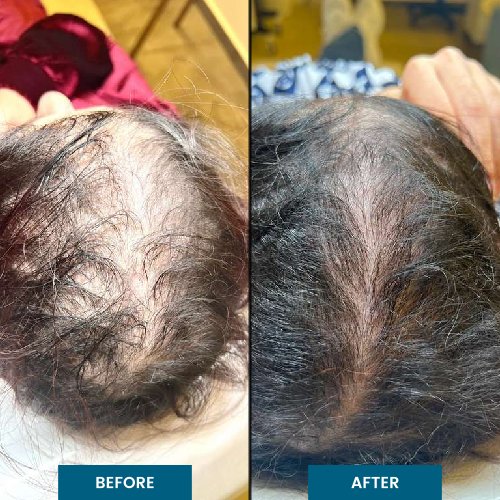 Exosome Hair Therapy in South Surrey, BC