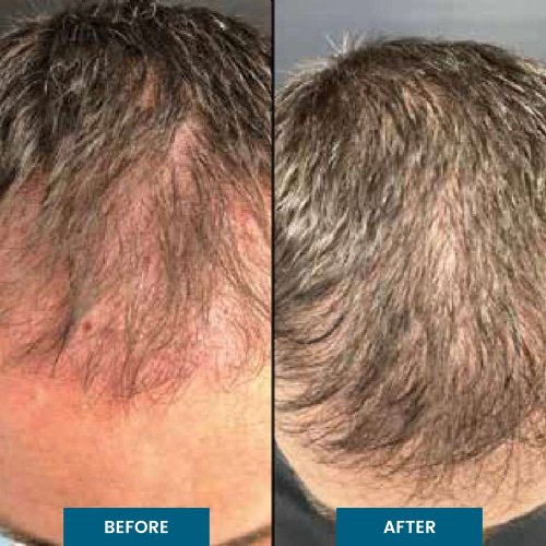 Exosome Hair Therapy in South Surrey, BC