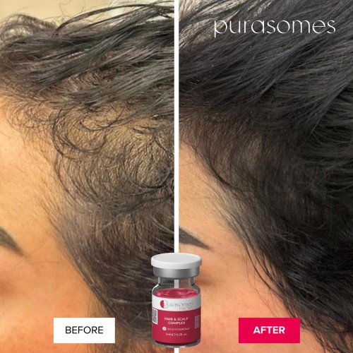 PRP Facial with Exosomes in South Surrey BC